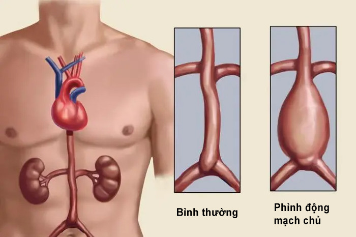 Bài kiểm tra với ngón tay cái phát hiện nguy cơ bệnh tim