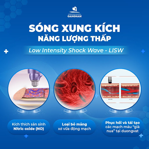 SÓNG XUNG KÍCH NAM KHOA? ỨNG DỤNG TRONG CẢI THIỆN RỐI LOẠN CƯƠNG DƯƠNG?