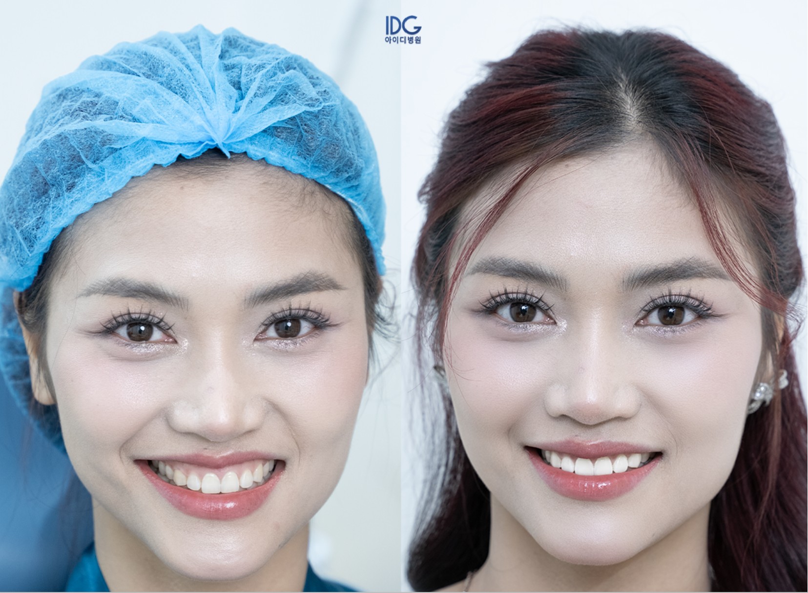 Công nghệ Gummy Smile Fill tại Trung tâm CNC IDG thu hút hàng nghìn người tìm đến. Trào lưu hay hướng đi khác biệt?